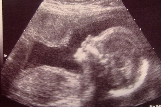 Ultrasound of preborn baby